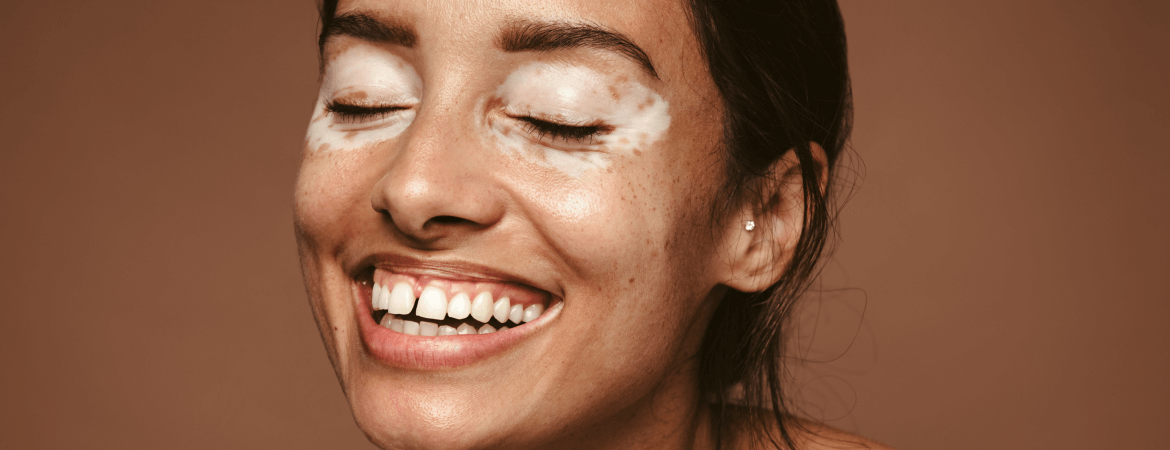 5 things to know about vitiligo