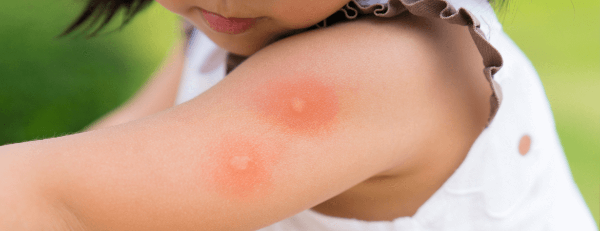Food allergies in children